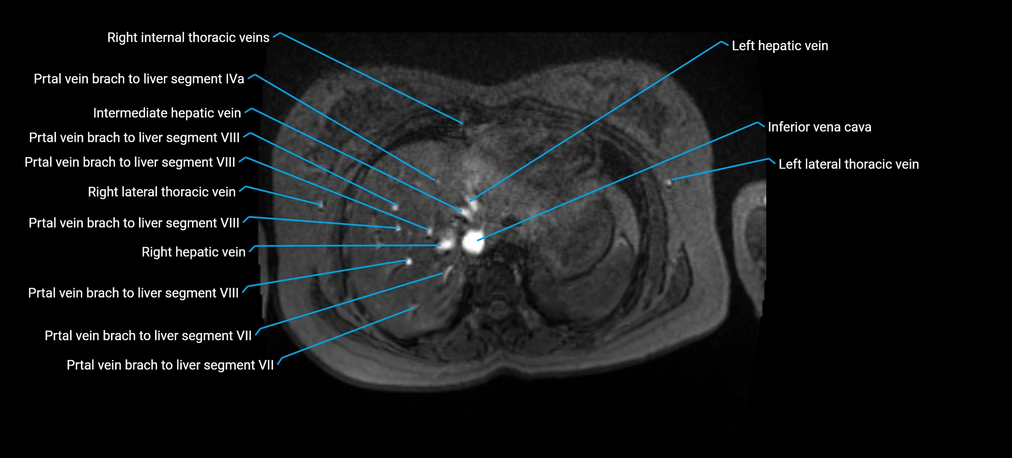 MRV abdomen pelvis & lower limb axial cross sectional anatomy labelled MRI image 22 (1).webp